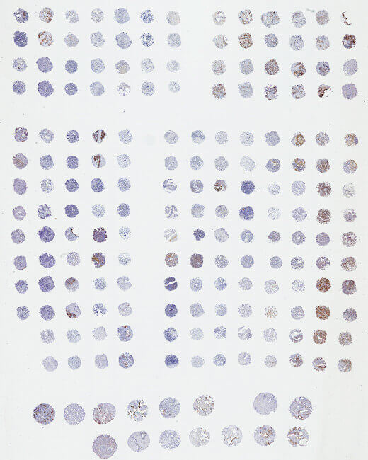 Tissue Microarray