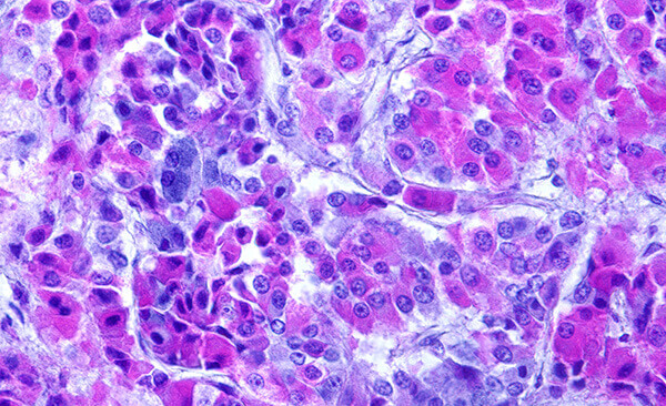 Ocular Pathology