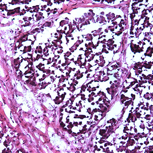 Spontaneous Rhabdomyosarcoma, H&E