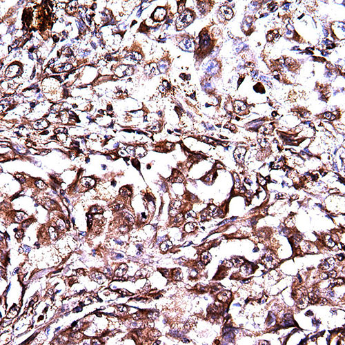 Nude Mouse Lung Cancer, MMP9, IHC